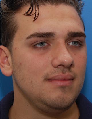 Favorite Revision Rhinoplasty Before & After Gallery - Patient 396626 - Image 6