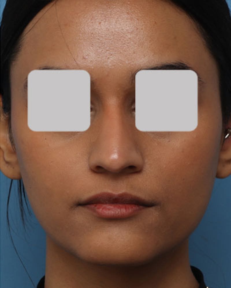 Rhinoplasty Before & After Gallery - Patient 111597 - Image 4