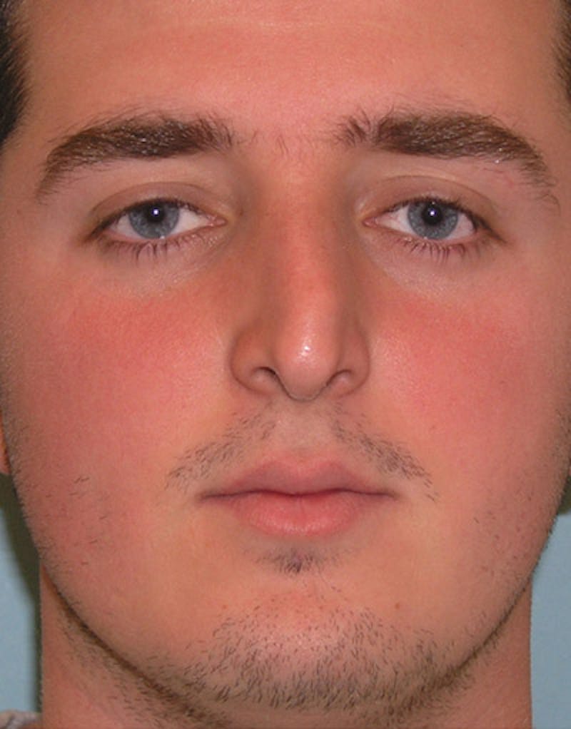 Patient V3J_P_I6QlShuTayhHeFeg - Foundation Rhinoplasty Before & After Photos