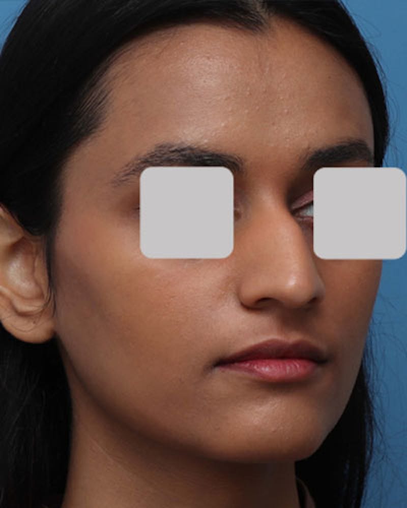 Rhinoplasty Before & After Gallery - Patient 111597 - Image 5