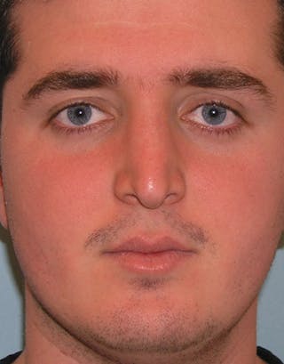 Rhinoplasty Before & After Gallery - Patient 239598 - Image 2