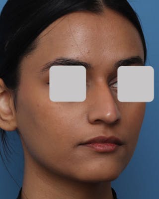 Favorite Foundation Rhinoplasty / Crooked Nose Before & After Gallery - Patient 407485 - Image 6