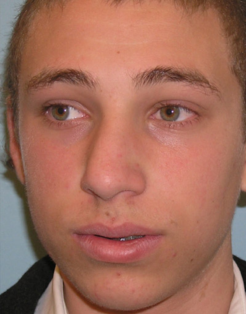 Male Rhinoplasty Before & After Gallery - Patient 179098 - Image 5