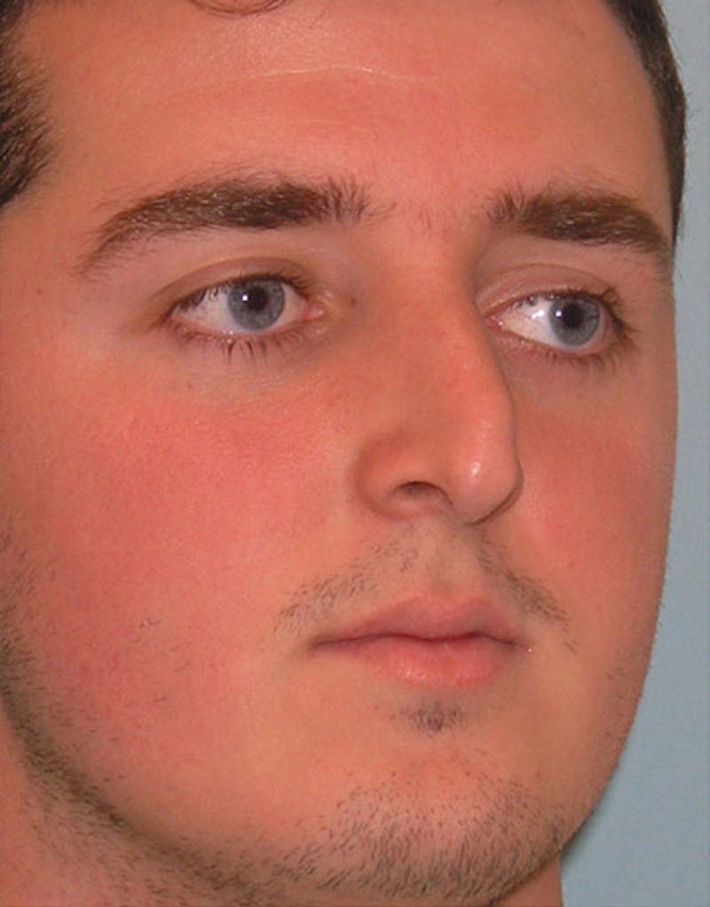 Rhinoplasty  Before & After Gallery - Patient 239598 - Image 3