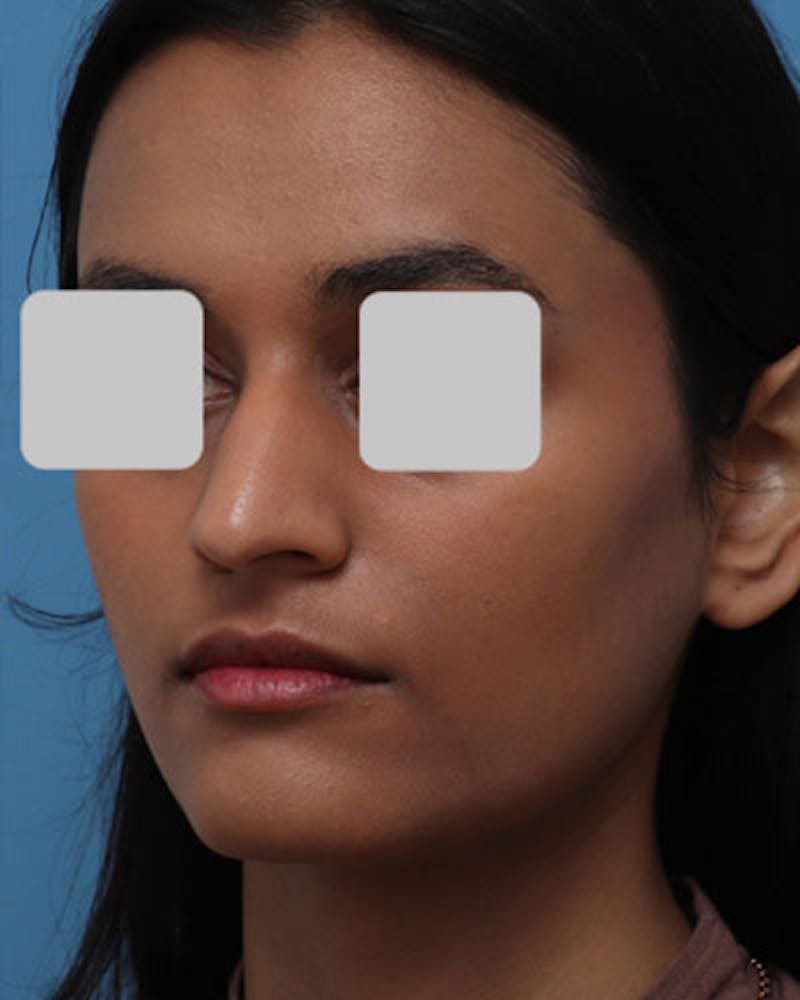 Favorite Foundation Rhinoplasty / Crooked Nose Before & After Gallery - Patient 407485 - Image 7