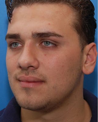 Favorite Revision Rhinoplasty Before & After Gallery - Patient 396626 - Image 8