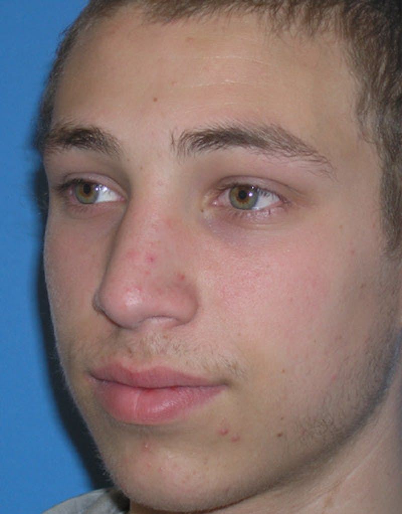 Male Rhinoplasty Before & After Gallery - Patient 179098 - Image 6