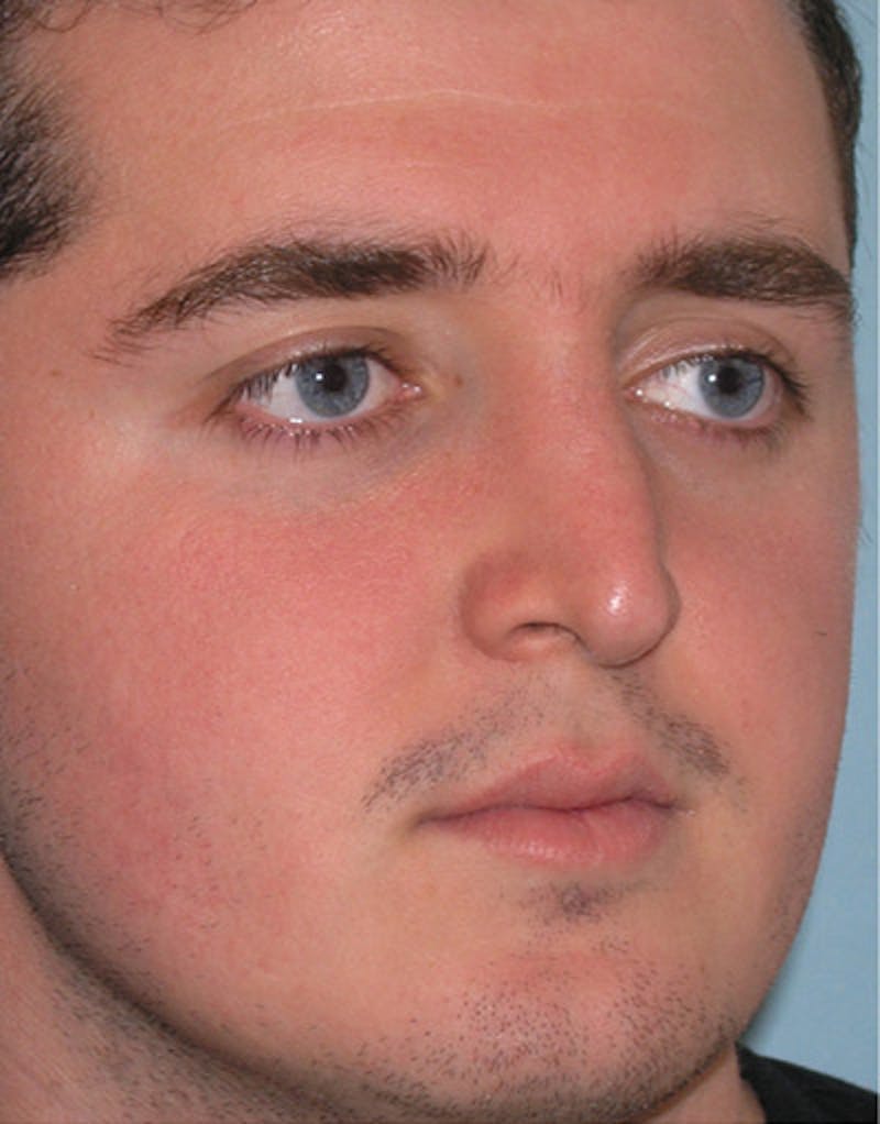 Foundation Rhinoplasty / Crooked Nose Before & After Gallery - Patient 340562 - Image 4