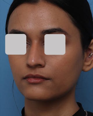 Favorite Foundation Rhinoplasty / Crooked Nose Before & After Gallery - Patient 407485 - Image 8