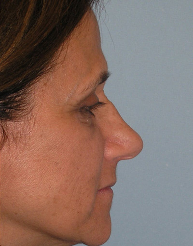 Revision Rhinoplasty Before & After Gallery - Patient 130438 - Image 1
