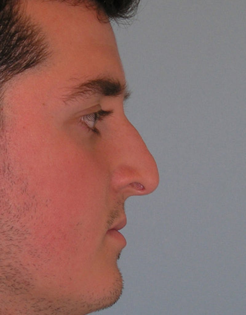 Foundation Rhinoplasty / Crooked Nose Before & After Gallery - Patient 340562 - Image 5