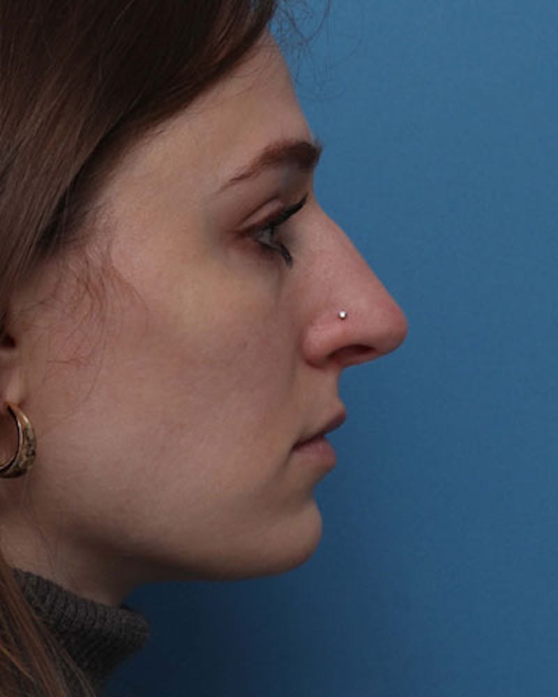 Patient btmKpixERweZZVggTiMF-g - Rhinoplasty Before & After Photos