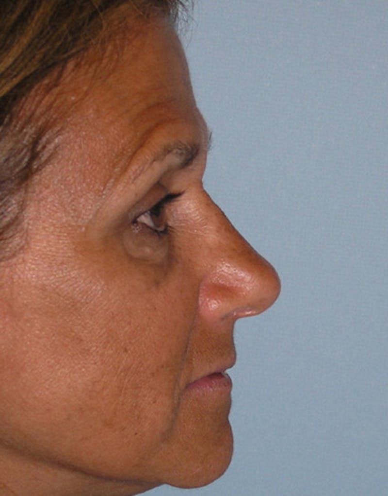 Revision Rhinoplasty Before & After Gallery - Patient 130438 - Image 2