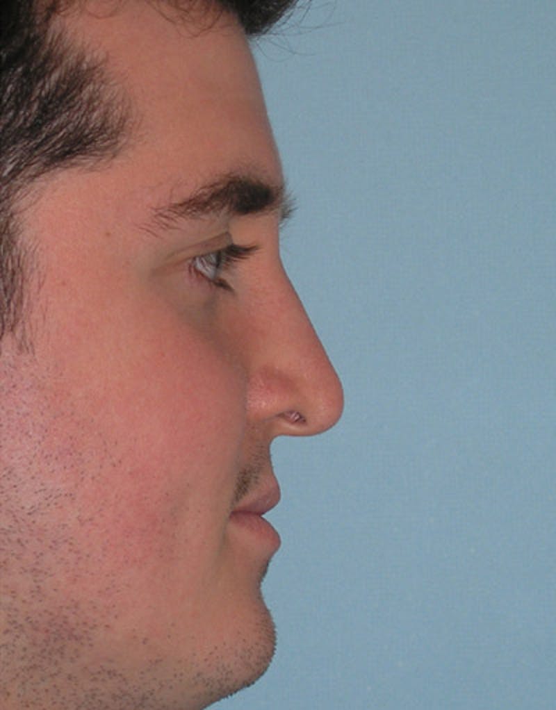 Foundation Rhinoplasty / Crooked Nose Before & After Gallery - Patient 340562 - Image 6