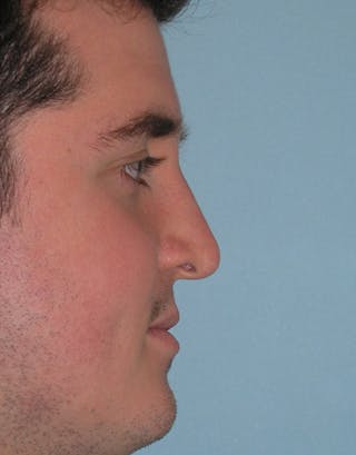 Rhinoplasty Before & After Gallery - Patient 239598 - Image 6