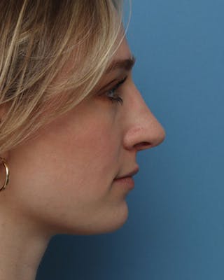 Rhinoplasty Before & After Gallery - Patient 307435 - Image 2