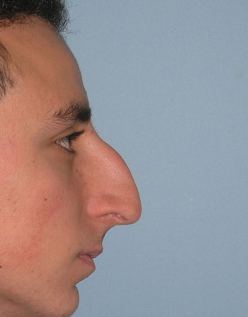 Patient KiCv_9QcSrKL9nMDwb4upA - Male Rhinoplasty Before & After Photos