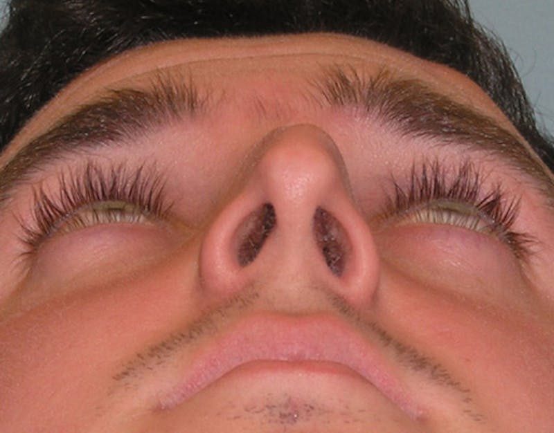 Foundation Rhinoplasty / Crooked Nose Before & After Gallery - Patient 340562 - Image 7