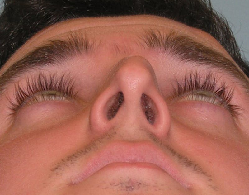 Rhinoplasty  Before & After Gallery - Patient 239598 - Image 7