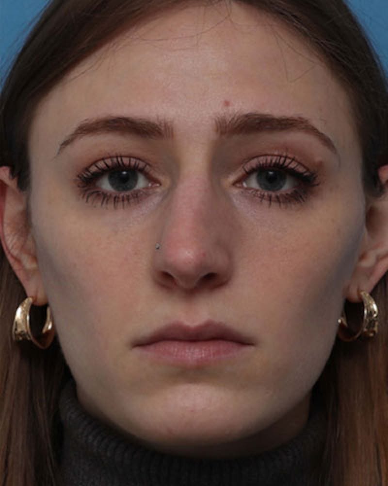 Rhinoplasty Before & After Gallery - Patient 409252 - Image 3