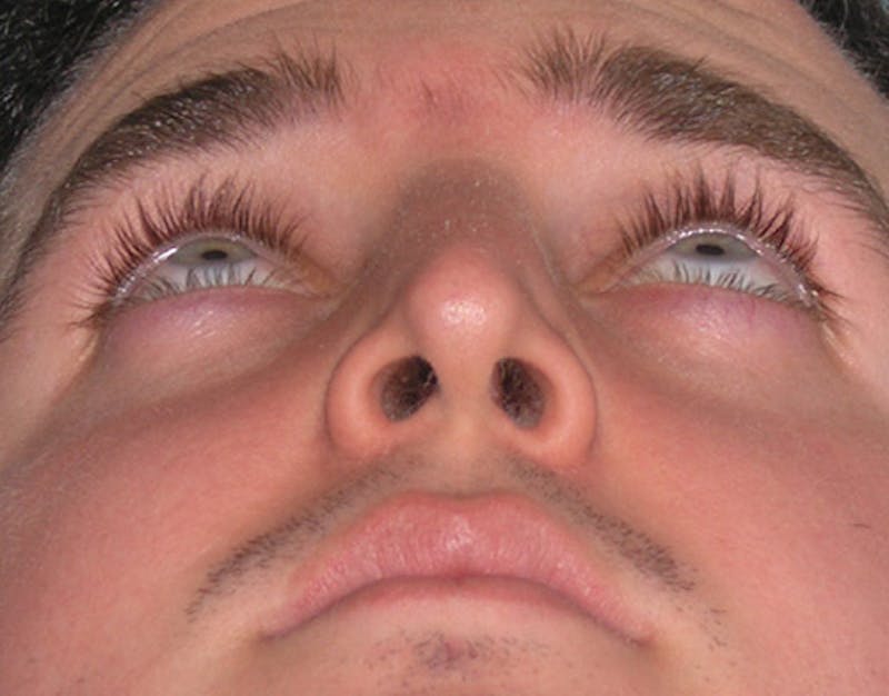 Rhinoplasty  Before & After Gallery - Patient 239598 - Image 8