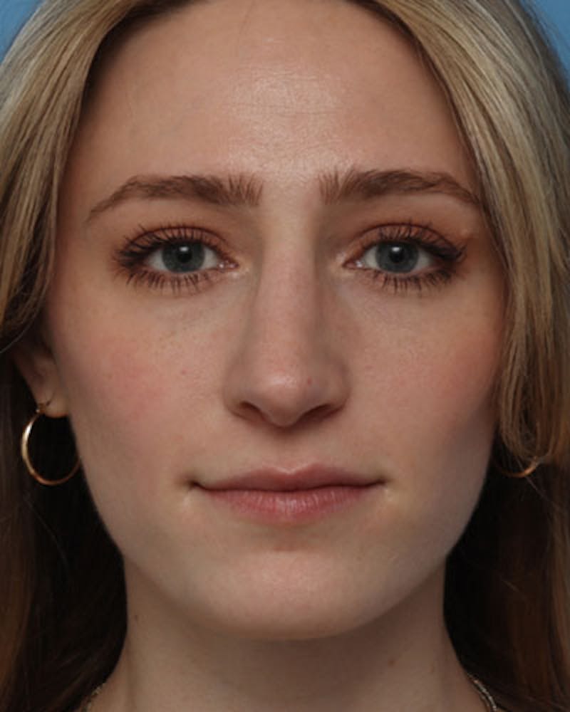 Rhinoplasty Before & After Gallery - Patient 409252 - Image 4
