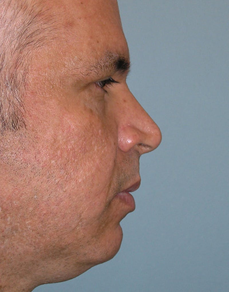 Male Rhinoplasty Before & After Gallery - Patient 158509 - Image 1