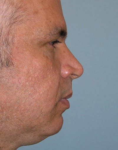 Rhinoplasty Before & After Gallery - Patient 324447 - Image 1