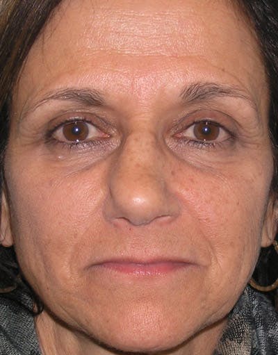Rhinoplasty Before & After Gallery - Patient 118943 - Image 1
