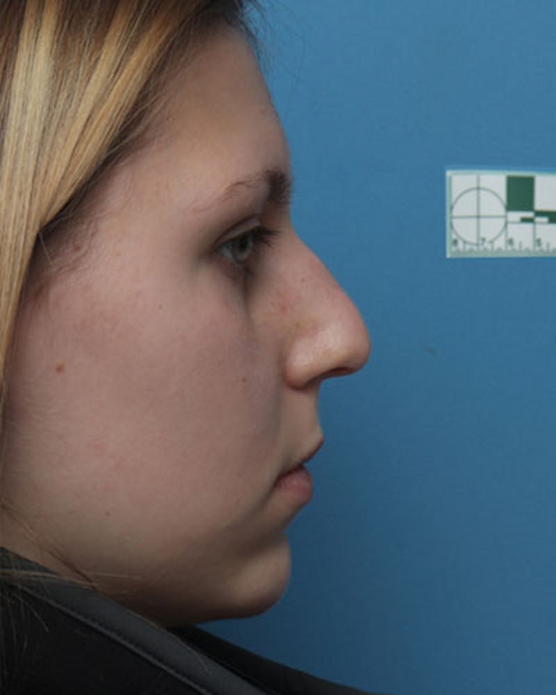 Patient ONuZ1uouRmGAbBxjIF2r_g - Rhinoplasty Before & After Photos