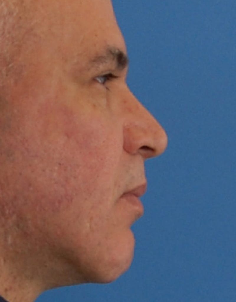 Male Rhinoplasty Before & After Gallery - Patient 158509 - Image 2