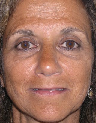 Rhinoplasty Before & After Gallery - Patient 118943 - Image 2
