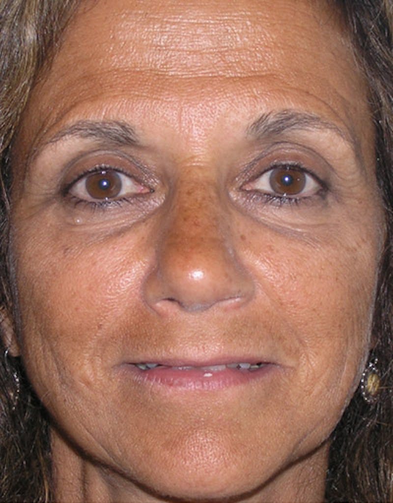 Foundation Rhinoplasty / Crooked Nose Before & After Gallery - Patient 128003 - Image 2