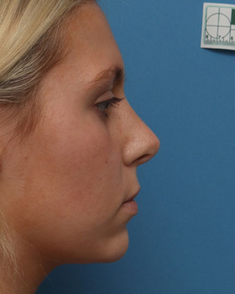Rhinoplasty Before & After Gallery - Patient 170904 - Image 2