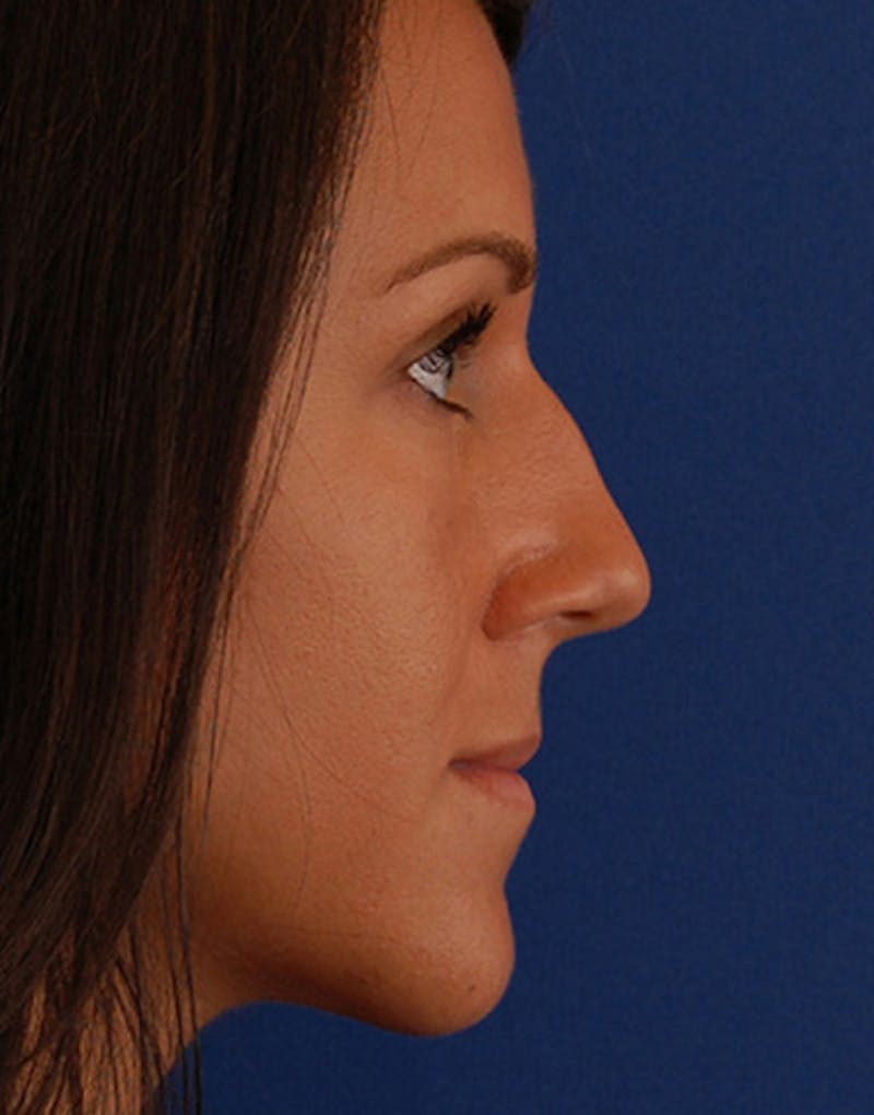 Revision Rhinoplasty Before & After Gallery - Patient 679234 - Image 1