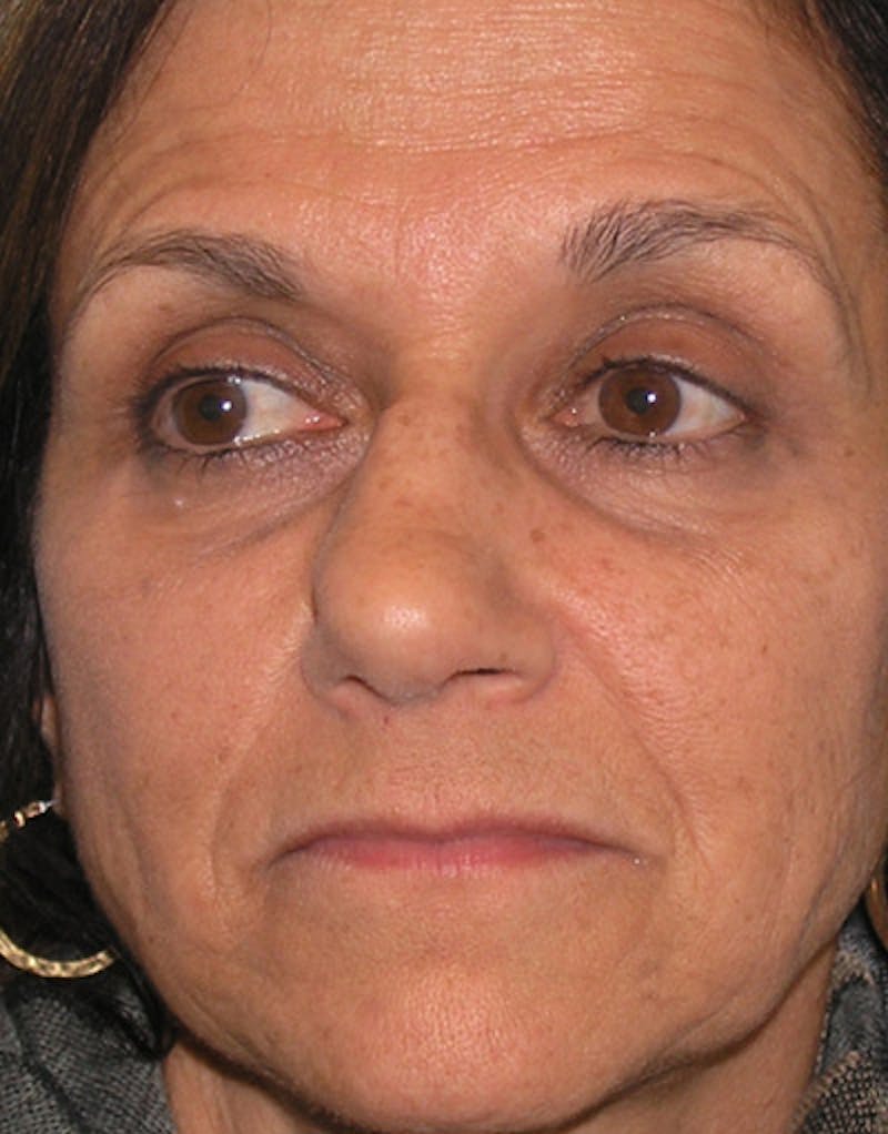 Rhinoplasty  Before & After Gallery - Patient 118943 - Image 3