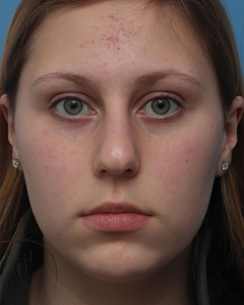 Rhinoplasty  Before & After Gallery - Patient 342097 - Image 3