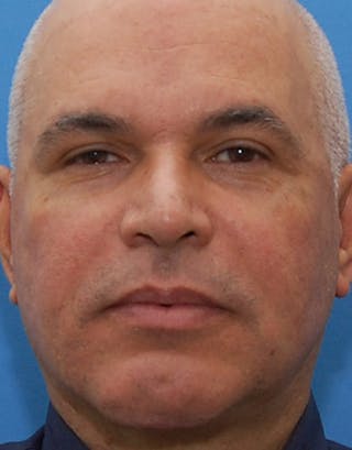 Rhinoplasty Before & After Gallery - Patient 324447 - Image 4