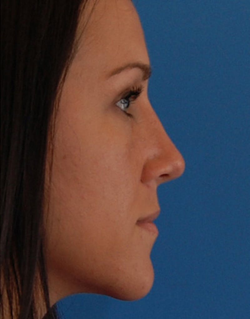 Revision Rhinoplasty Before & After Gallery - Patient 679234 - Image 2