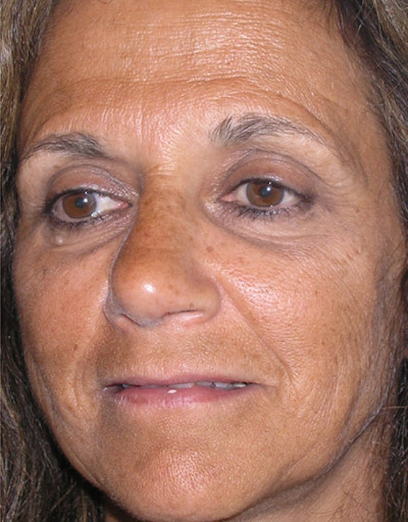 Rhinoplasty  Before & After Gallery - Patient 118943 - Image 4