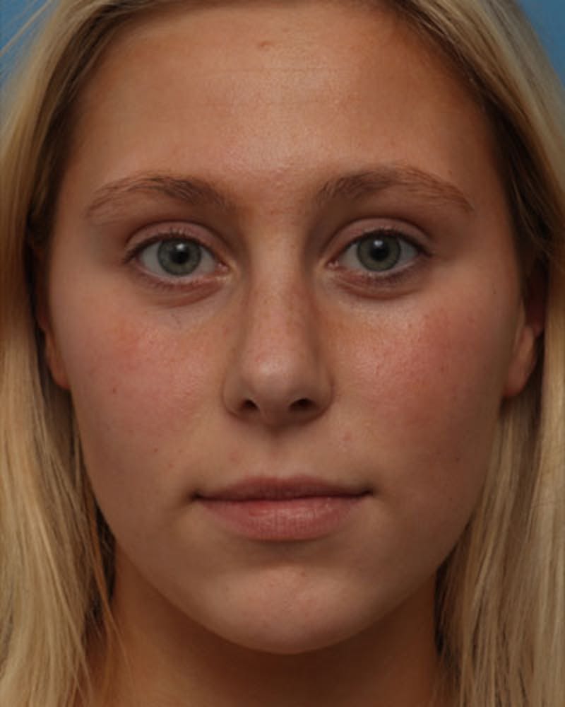 Rhinoplasty  Before & After Gallery - Patient 342097 - Image 4