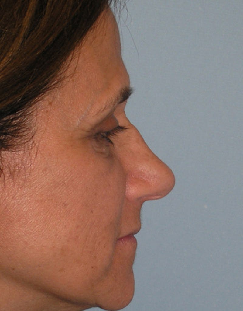 Foundation Rhinoplasty / Crooked Nose Before & After Gallery - Patient 128003 - Image 5