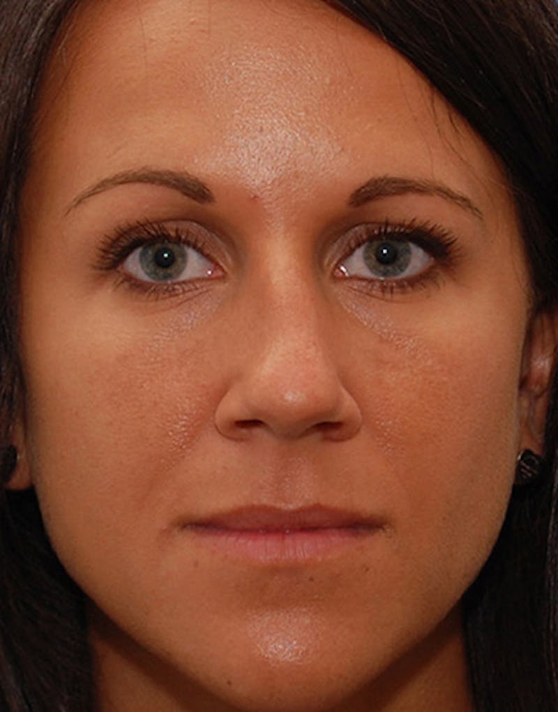 Revision Rhinoplasty Before & After Gallery - Patient 679234 - Image 3