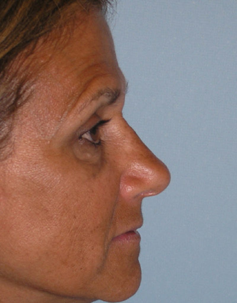 Foundation Rhinoplasty / Crooked Nose Before & After Gallery - Patient 128003 - Image 6