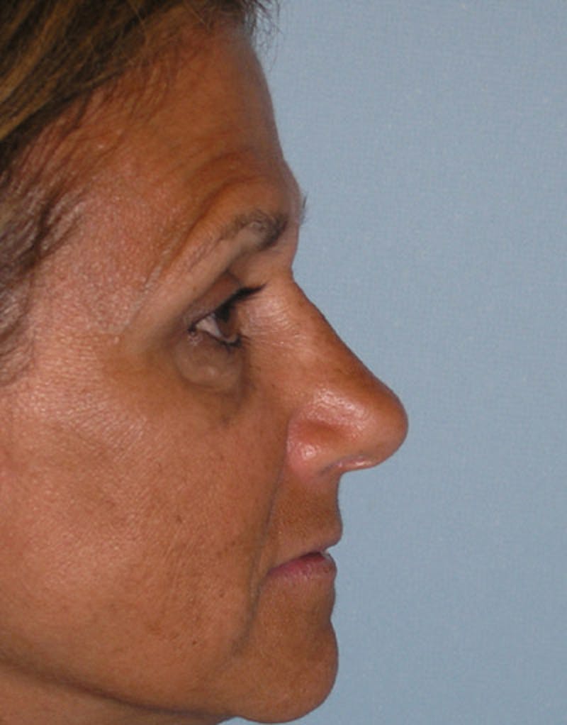 Rhinoplasty  Before & After Gallery - Patient 118943 - Image 6