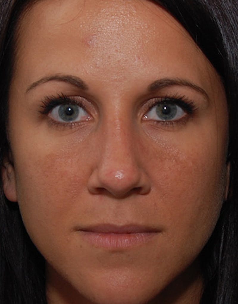 Revision Rhinoplasty Before & After Gallery - Patient 679234 - Image 4