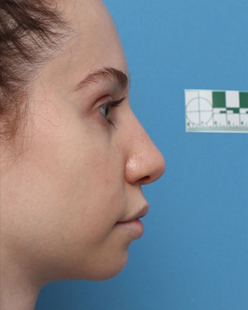 Patient TeI3KPNwSYmCgk3JxndAZg - Rhinoplasty Before & After Photos