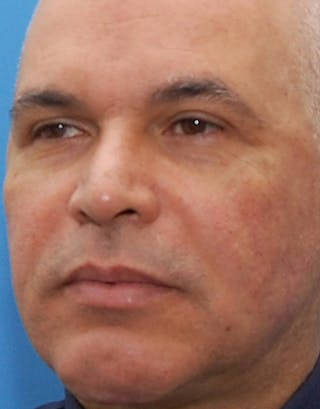 Rhinoplasty Before & After Gallery - Patient 324447 - Image 6