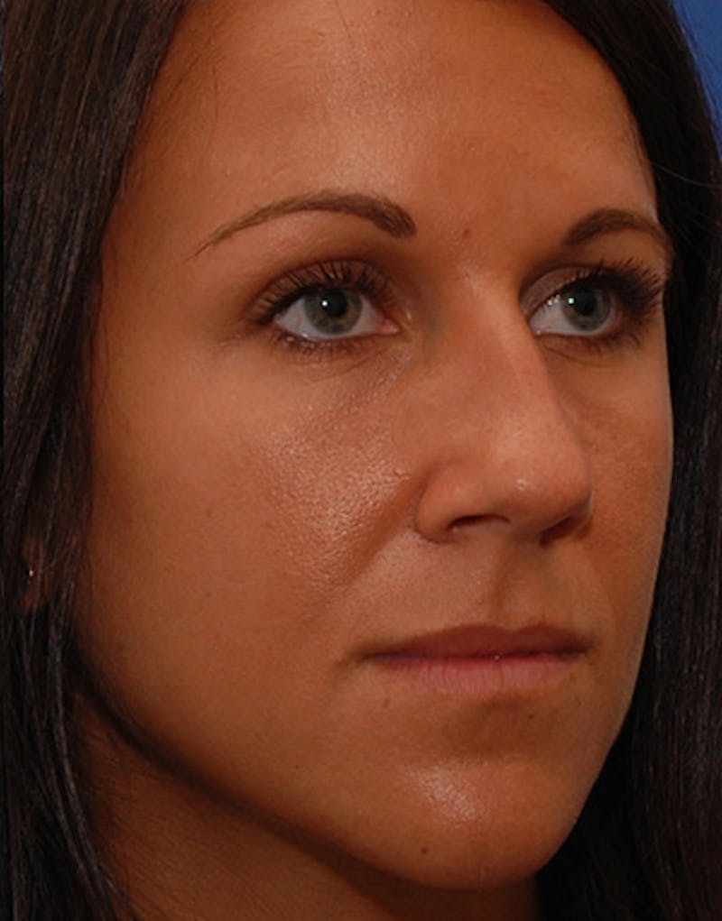 Revision Rhinoplasty Before & After Gallery - Patient 679234 - Image 5