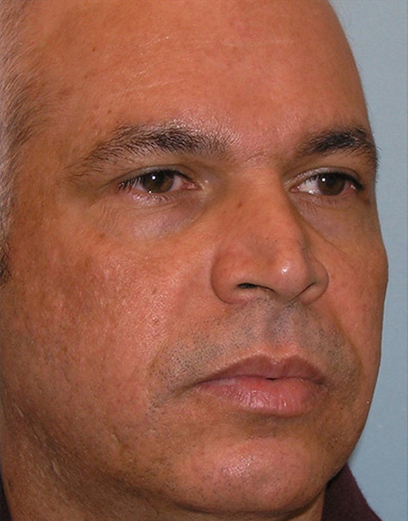 Rhinoplasty  Before & After Gallery - Patient 324447 - Image 7